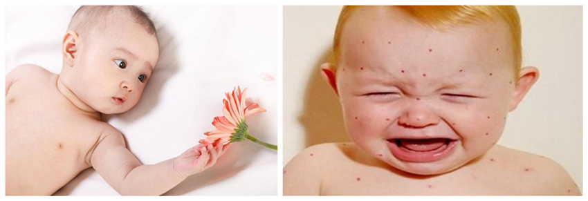 兒童濕疹反反復(fù)復(fù)，您有在家安裝家用除濕產(chǎn)品嗎？